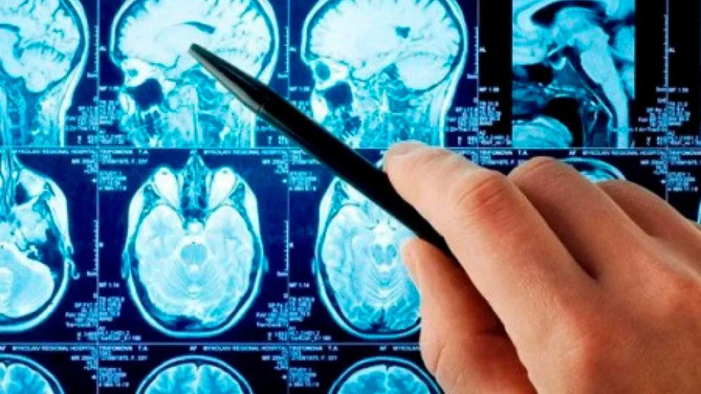 Aneurisma cerebral: ¿de qué se trata esta patología?